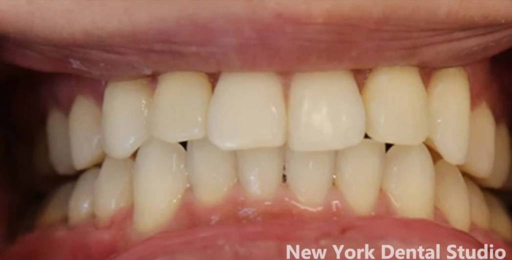 before-after-invisalign-picture-1
