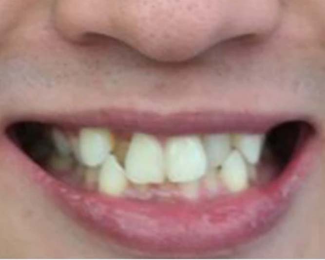 before-after-invisalign-picture-4