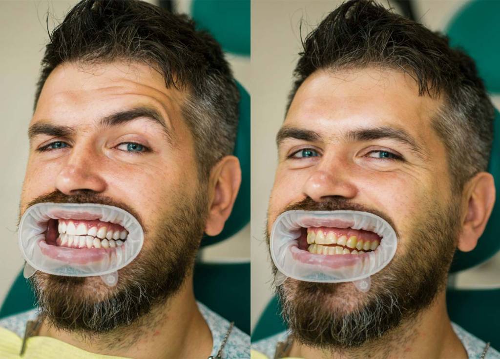 professional teeth whitening nyc