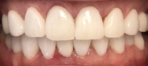 full-mouth-veneers-after