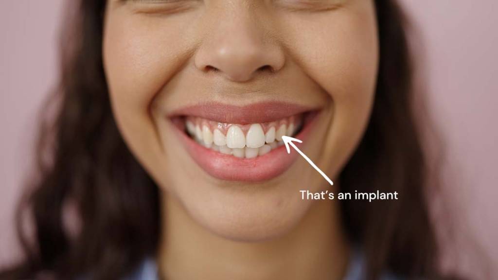 dental-implant-nyc-manhattan