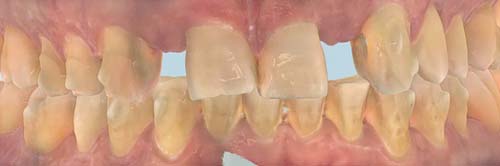 dental-implants-before-after-1