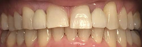dental-implants-before-after-2