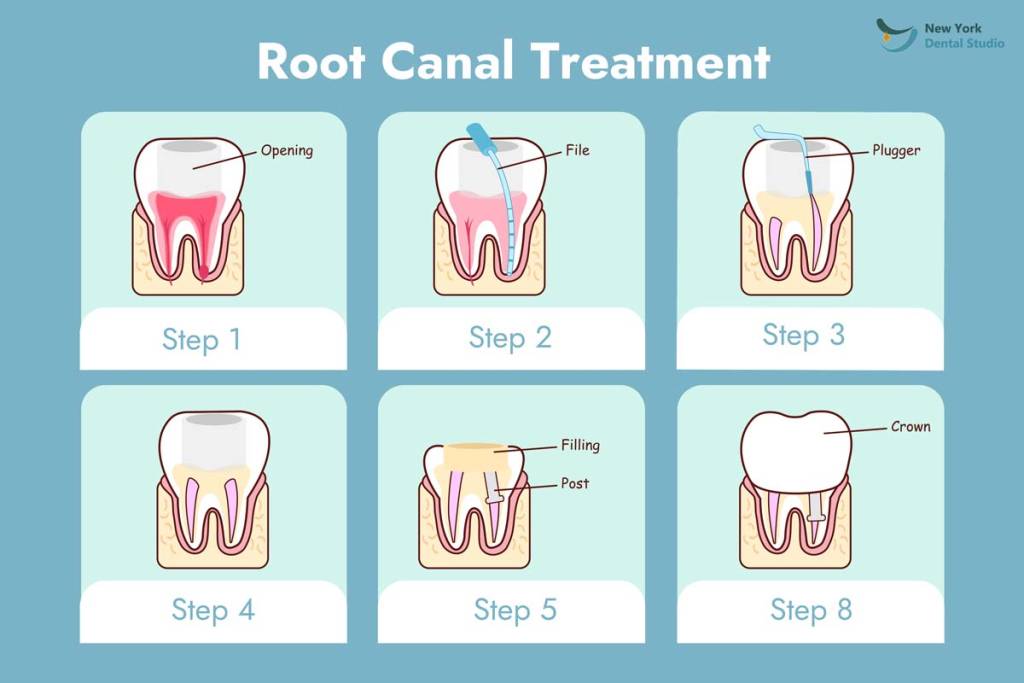 root-canal-treatment-nyc