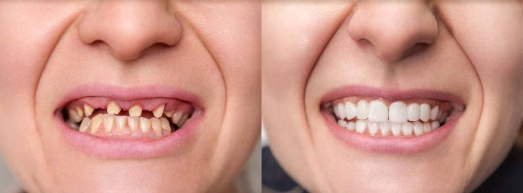 veneers-before-after-small-teeth