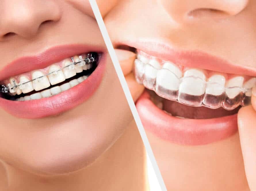 Invislign vs Braces