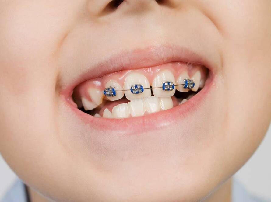 braces for children