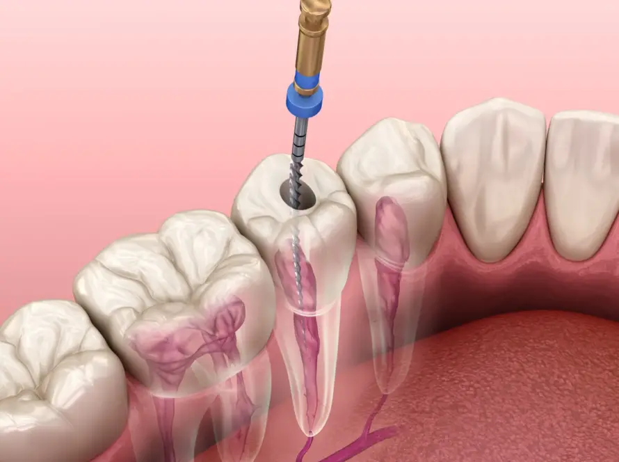 root canal treatment