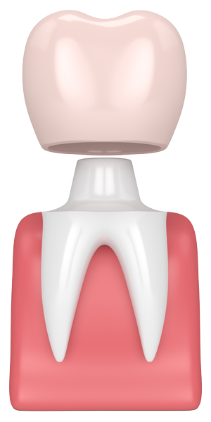 dental-crown-nyc-upper-east-side